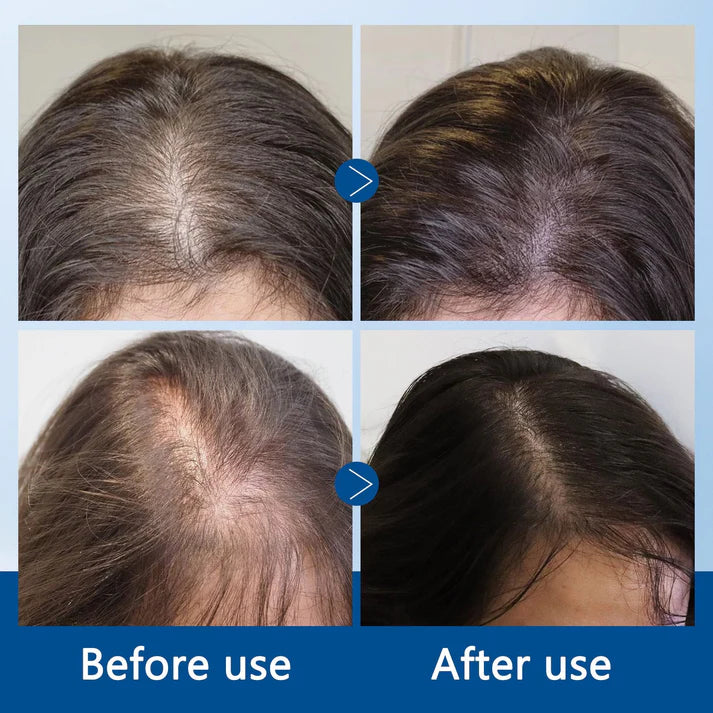 Juxek Advanced Hair Growth Roll-On Serum | 3% Rosemary | 2% Aminexil | 3% Redensyl | 2% Anagain | Precision Scalp Applicator | Paraben & Sulphate Free | Non-Oily & Mess-Free